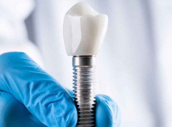 Implant Treatment Process, Benefits, and Care